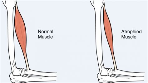 Muscle Atrophy Latest Facts: Causes, Types, Symptoms and Treatment - Gilmore Health News