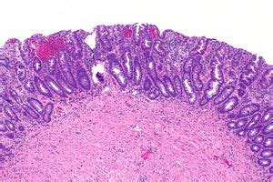 Tubular adenoma of the urinary tract - Libre Pathology