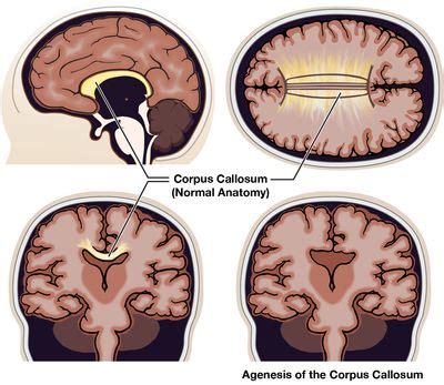 Agenesis of the Corpus Callosum