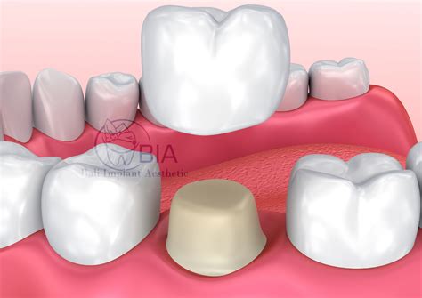 Onlay VS Dental Crown - Bali Implant Aesthetic (BIA) Dental Center