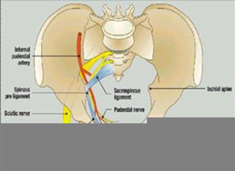 Sacrospinous Ligament Suspension