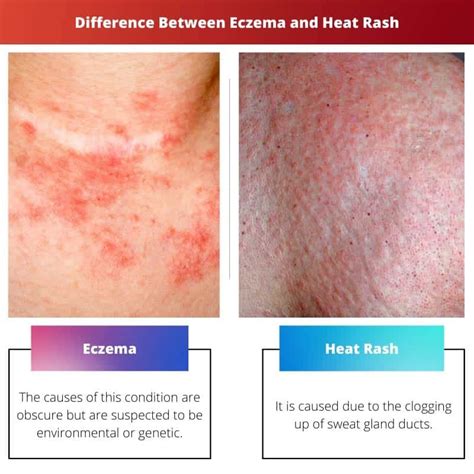 Eczema vs Heat Rash: Difference and Comparison