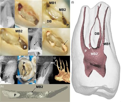 Undiscovered Anatomical Structure in Maxillary Second Molars