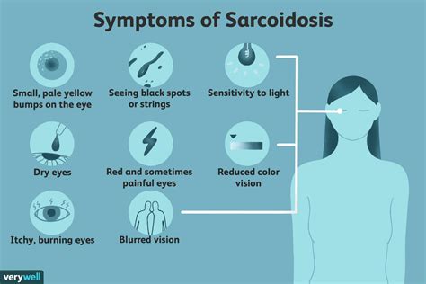 Ocular Sarcoidosis: Symptoms, Causes, and Diagnosis