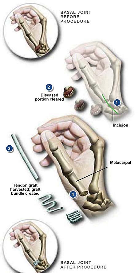 Basal Joint Surgery | Central Coast Orthopedic Medical Group