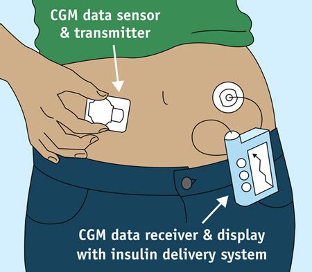 Best Continuous Glucose Monitoring System 2022