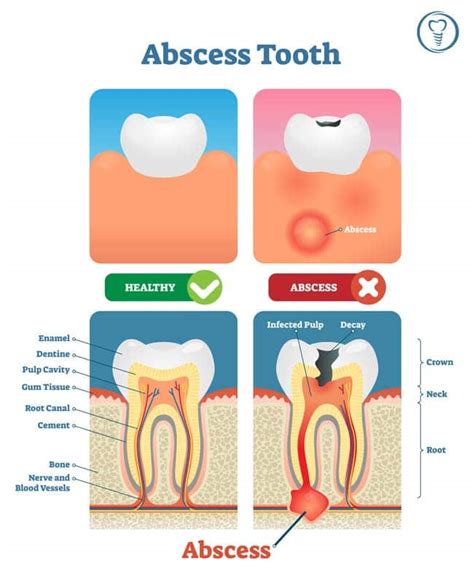 Dental Abscess - Stages, Causes, Symptoms & Treatments | Blog