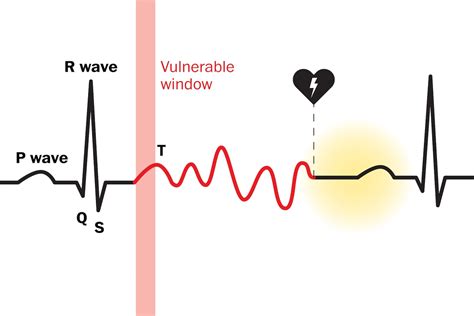 Commotio cordis triggers cardiac arrest in athletes, but risks can be mitigated - The Washington ...