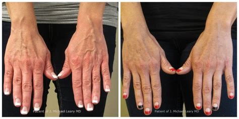 Hand Rejuvenation Orange County | Hand Resurfacing Newport Beach