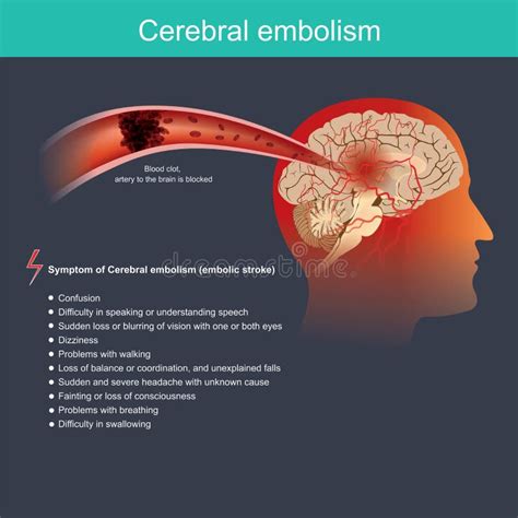 Cerebral Embolism. Infographic Illustration. Anatomical Human and Health Care. Stock Vector ...