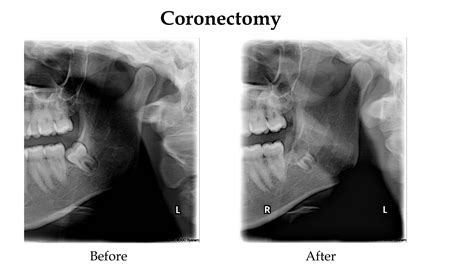 Coronectomy on wisdom teeth. Procedure is also known as tooth ...