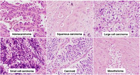 Histological profile of carcinomas of the lung and pleura. Stain:... | Download Scientific Diagram