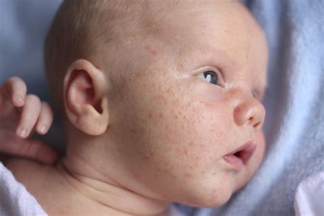 Why Does My Newborn Have Acne?