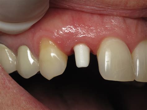 Shaping And Forming Gum Around Front Teeth Dental Implants