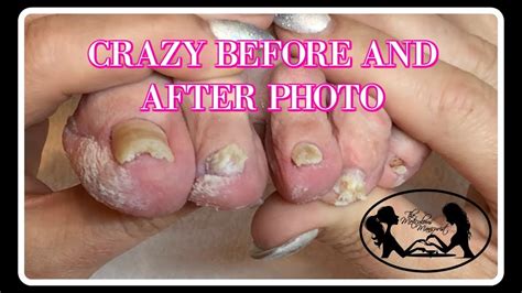 👣Pedicure at Home Elderly Nail Fungus Follow Up Tutorial 👣 ️ - Make Glam