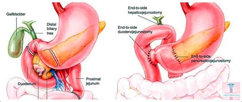 Affordable Whipple Surgery Cost in India : Indian Med Guru Consultants