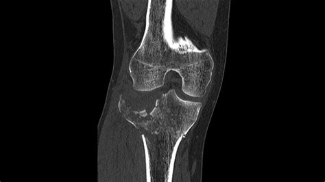 Tibial plateau fracture surgery - wikidoc