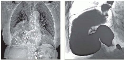 Gastric Volvulus | Radiology Key