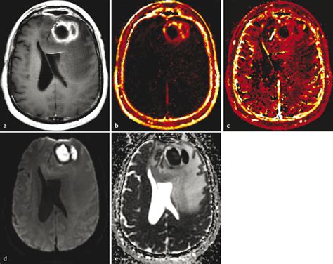 5 Perfusion Imaging: Dynamic Contrast-Enhanced T1-Weighted MRI (DCE-MRI) Perfusion | Radiology Key