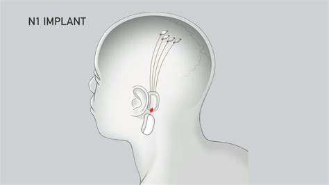 Elon Musk Details Neuralink Brain Interface Tech, Oculus CTO Calls It "very bold work"