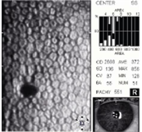 Use Specular Microscopy to Diagnose Corneal Disease