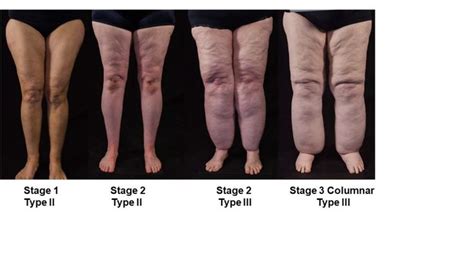 Subcutaneous Adipose Tissue Diseases: Dercum Disease, Lipedema ...