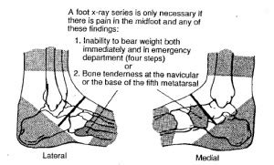 Ottawa ankle rules - WikEM