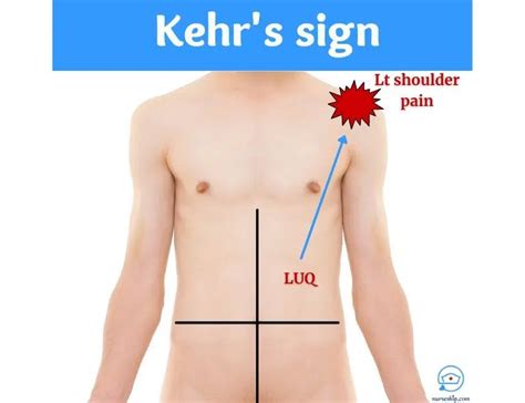 Kehr’s Sign |causes |how to assess - Nurseship.com