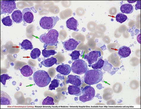 Large B Cell Lymphoma Cytology Small Jpg | Video Bokep Ngentot