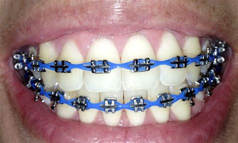 Different Color Metal Braces - Hair Color Loreal