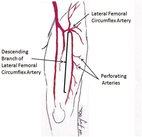 Application of Free Flow‐Through Anterolateral Thigh Flap for the Reconstruction of an Extremity ...