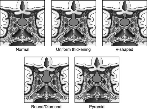 Imaging configurations of pituitary stalk abnormalities on MRI ...