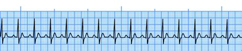 How to Diagnose ANY Cardiac Rhythm Systematically – Blogging For Your Noggin: Nursing Education ...