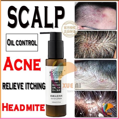 Scalp folliculitis red and swollen acne anti-dandruff and antiitchy ...