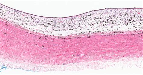 Eye – Retina, Choroid and Sclera – NUS Pathweb :: NUS Pathweb