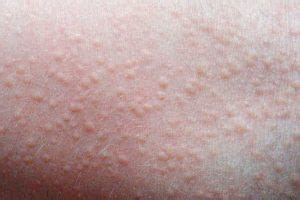 5 Common Skin Conditions/Rashes in Babies/Children | Kids Clinic