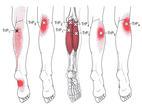 Gastrocnemius | The Trigger Point & Referred Pain Guide | Trigger ...