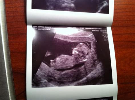 Week 12 Ultrasound - Fetal Nuchal Translucency Test Via Ultrasound ...