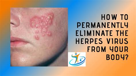 How To Permanently Eliminate the Herpes Virus from Your Body? - YouTube