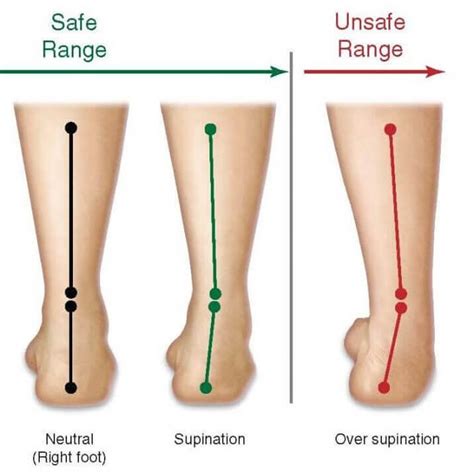 Underpronation, Supinated and High Arched Foot