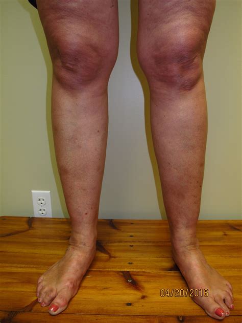 Lipedema — Symmetry Laser Vein Center