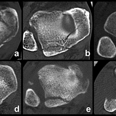 Types of medial malleolar fractures. a Fracture of anterior colliculus... | Download Scientific ...