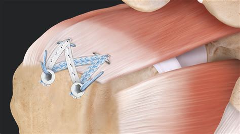 Arthrex - SpeedBridge™ Rotator Cuff Repair With Medial Ripstop Sutures and Knotless SwiveLock ...