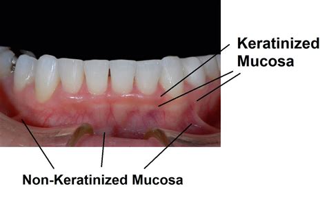 What is the difference between keratinized and non-keratinized mucosa? | News | Dentagama