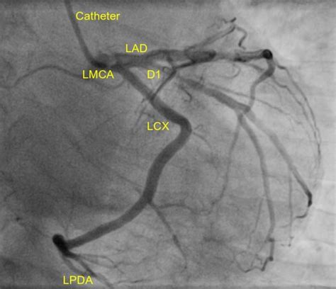 Dominant left coronary artery – All About Cardiovascular System and Disorders