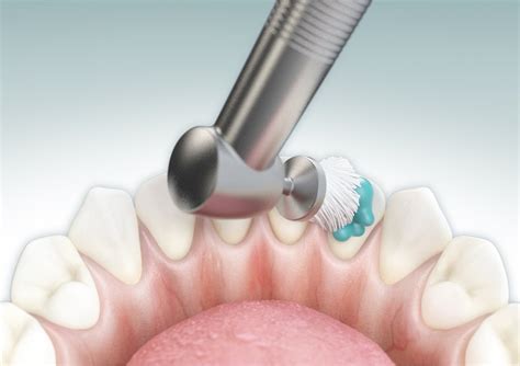 Coronal Polishing And Sealants Certification - prntbl ...