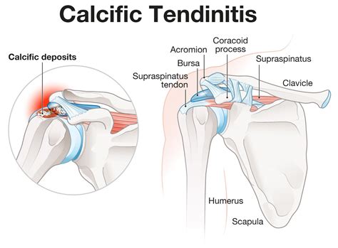 Calcific Tendinitis of the Shoulder | Complete Physio