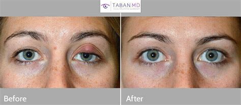 Eyelid Chalazion Surgery Before and After Gallery | Taban MD