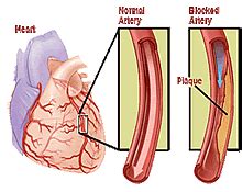 Vasospastic Angina: Vasospastic Angina Symptoms