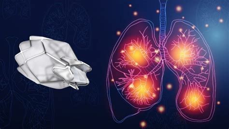 Pros And Cons Of The Zephyr Valve Procedure - Lung Institute